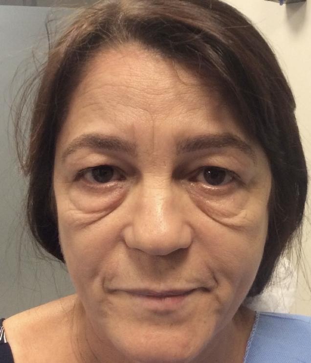 Paciente antes da blefaroplastia