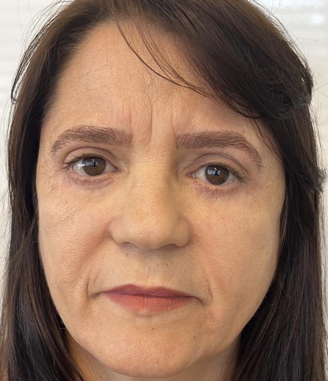 Paciente depois da blefaroplastia