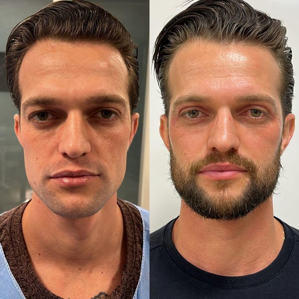 Antes e depois de blefaroplastia