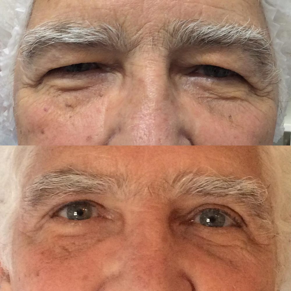 Antes e depois de blefaroplastia