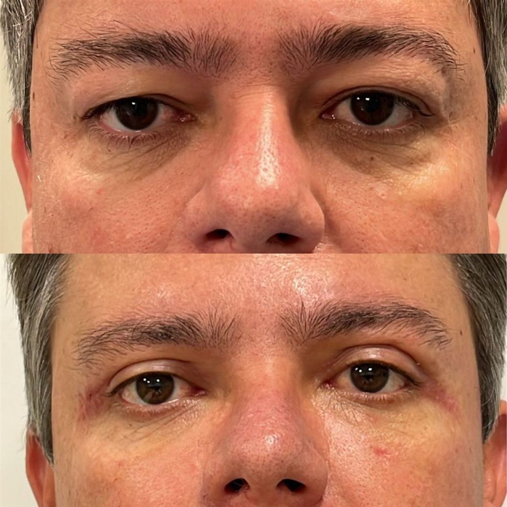 Antes e depois de blefaroplastia