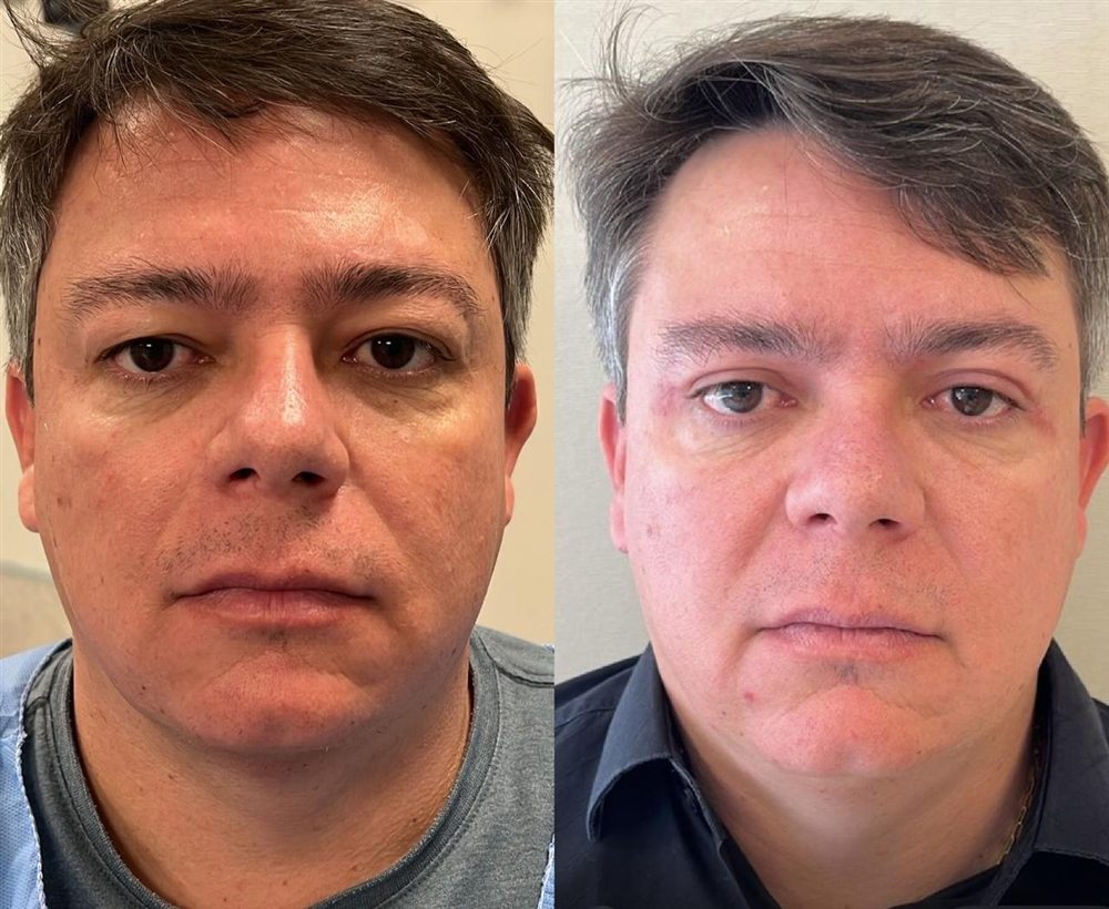 Antes e depois de blefaroplastia