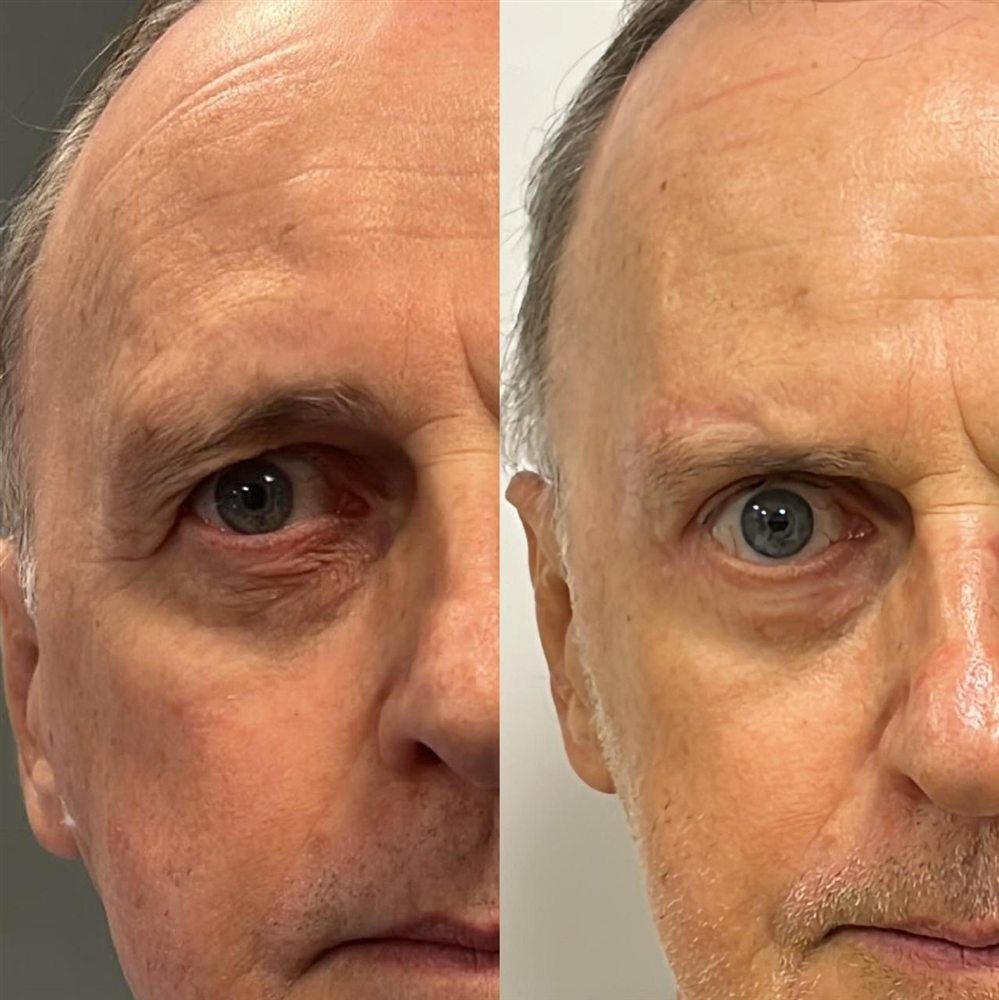 Antes e depois de blefaroplastia
