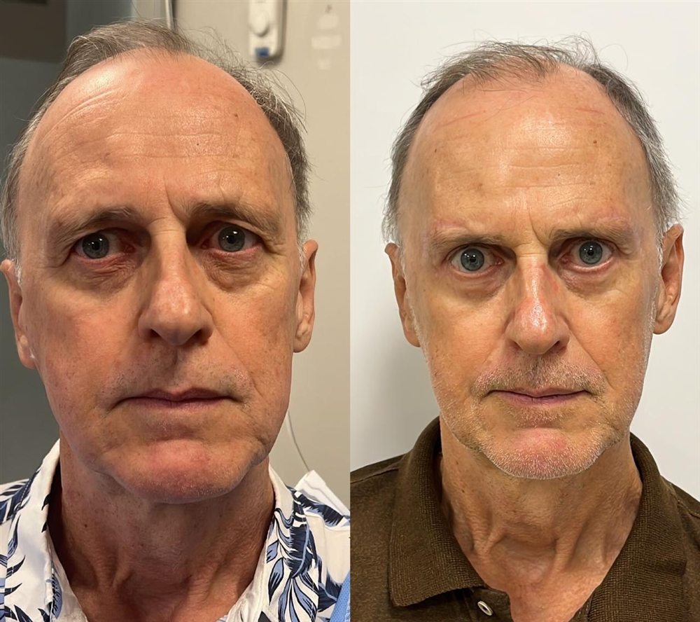 Antes e depois de blefaroplastia