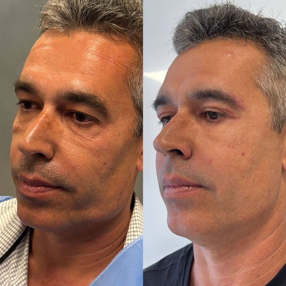 Antes e depois de blefaroplastia