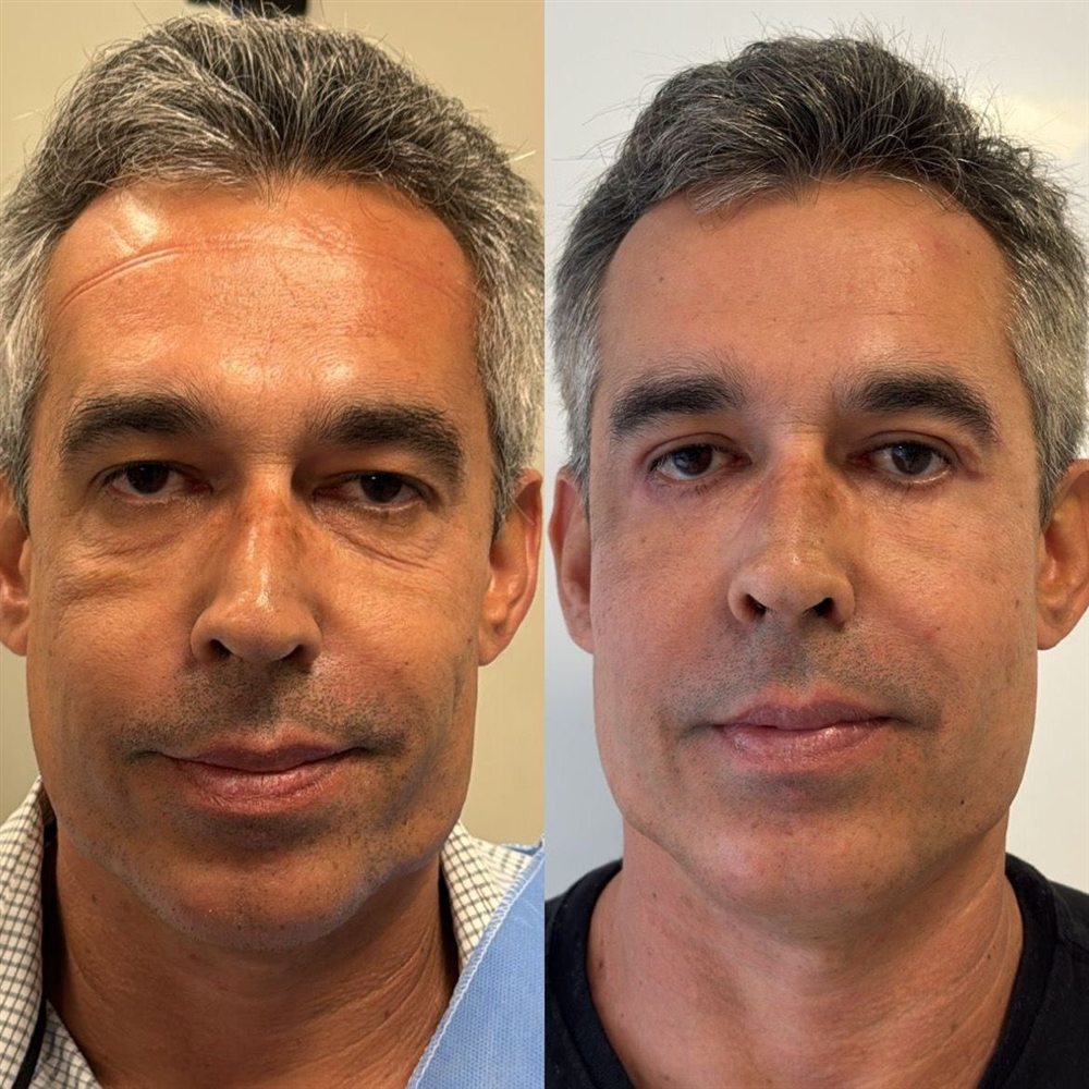 Antes e depois de blefaroplastia