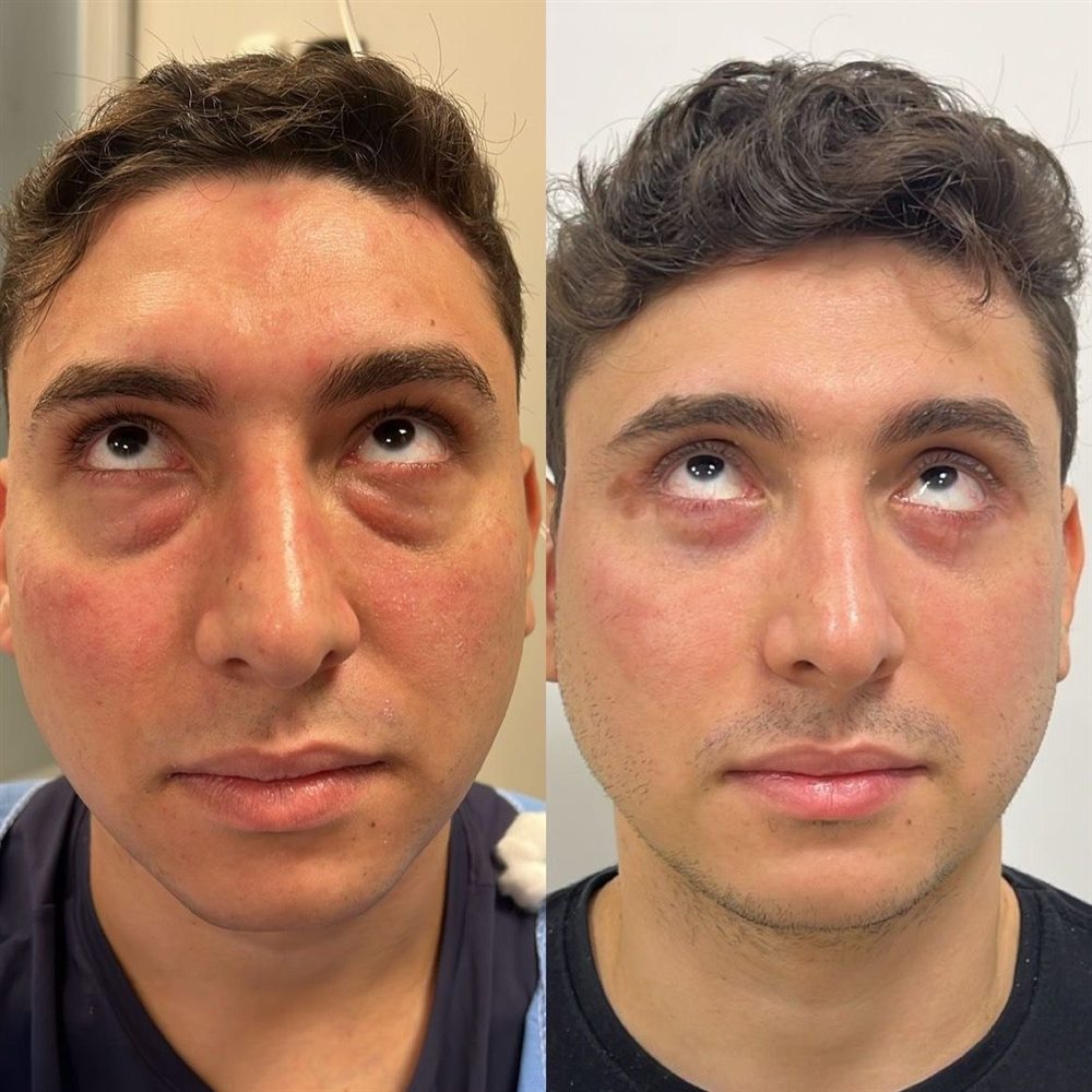 Antes e depois de blefaroplastia