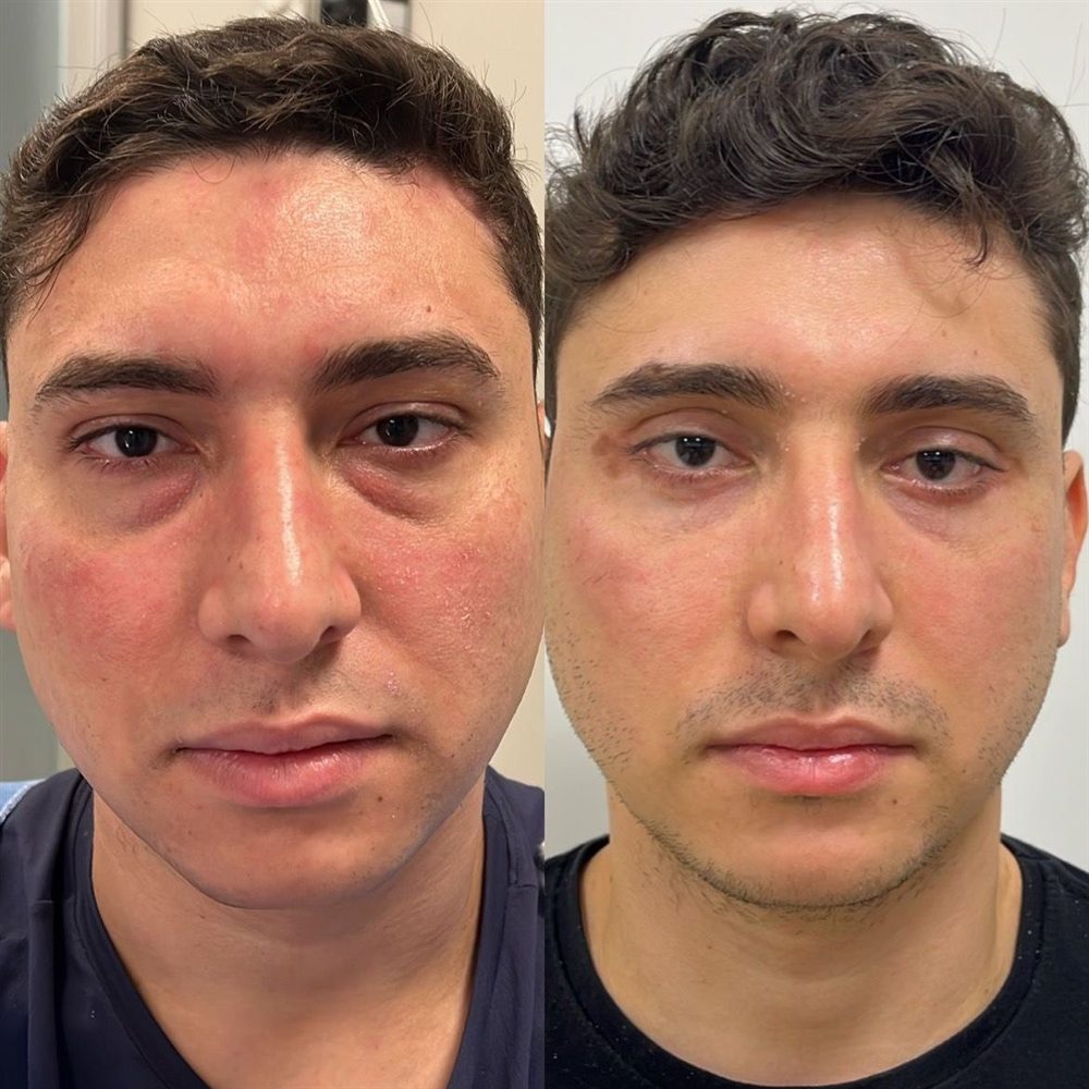 Antes e depois de blefaroplastia