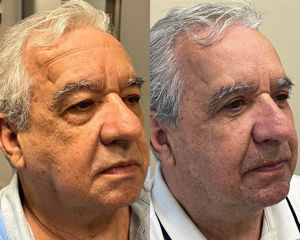 Antes e depois de blefaroplastia