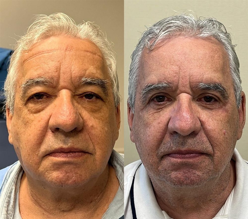 Antes e depois de blefaroplastia