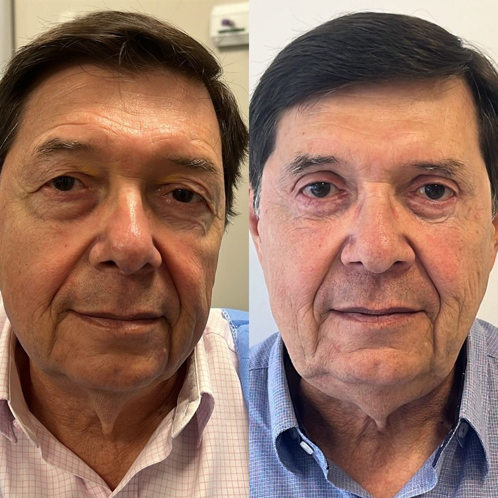 Antes e depois de blefaroplastia