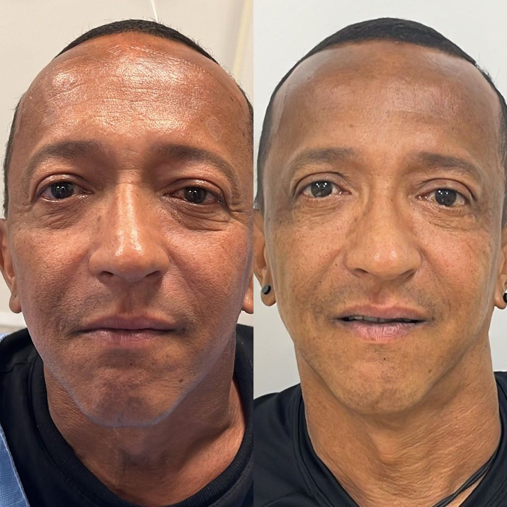 Antes e depois de blefaroplastia
