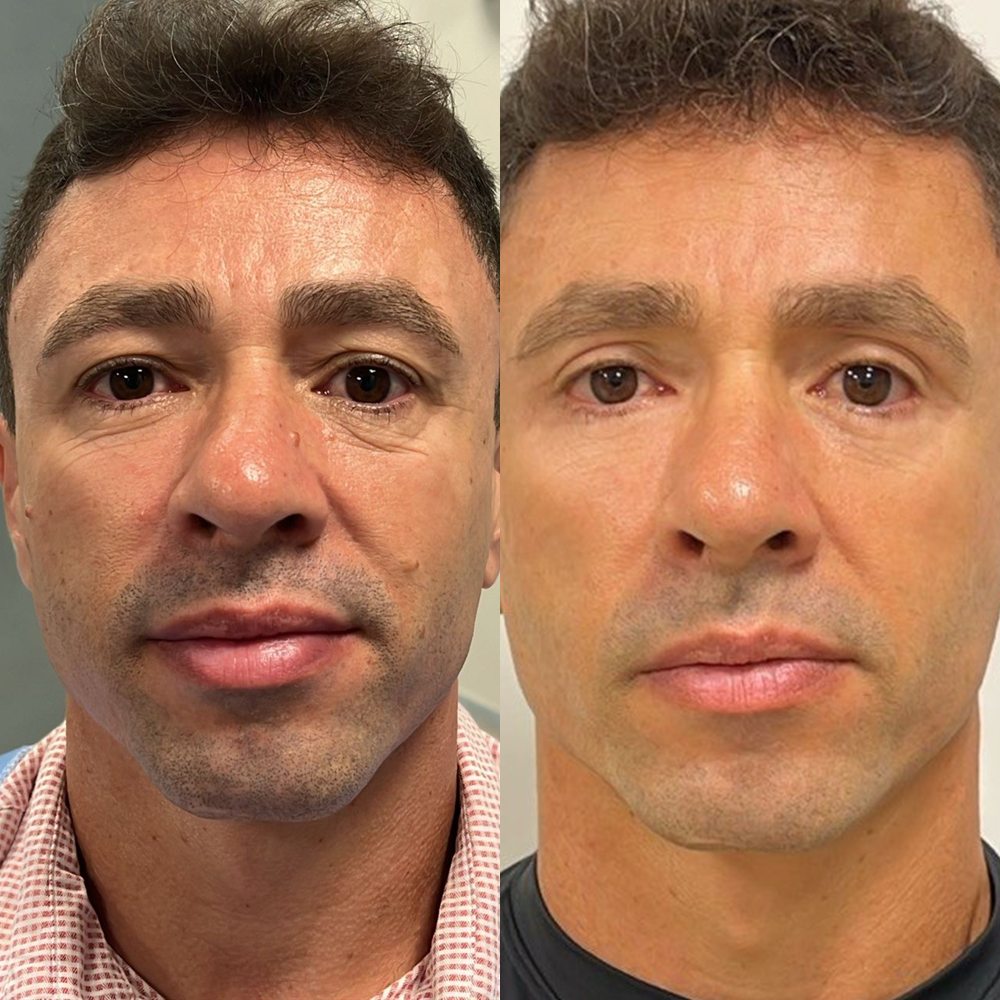 Antes e depois de blefaroplastia