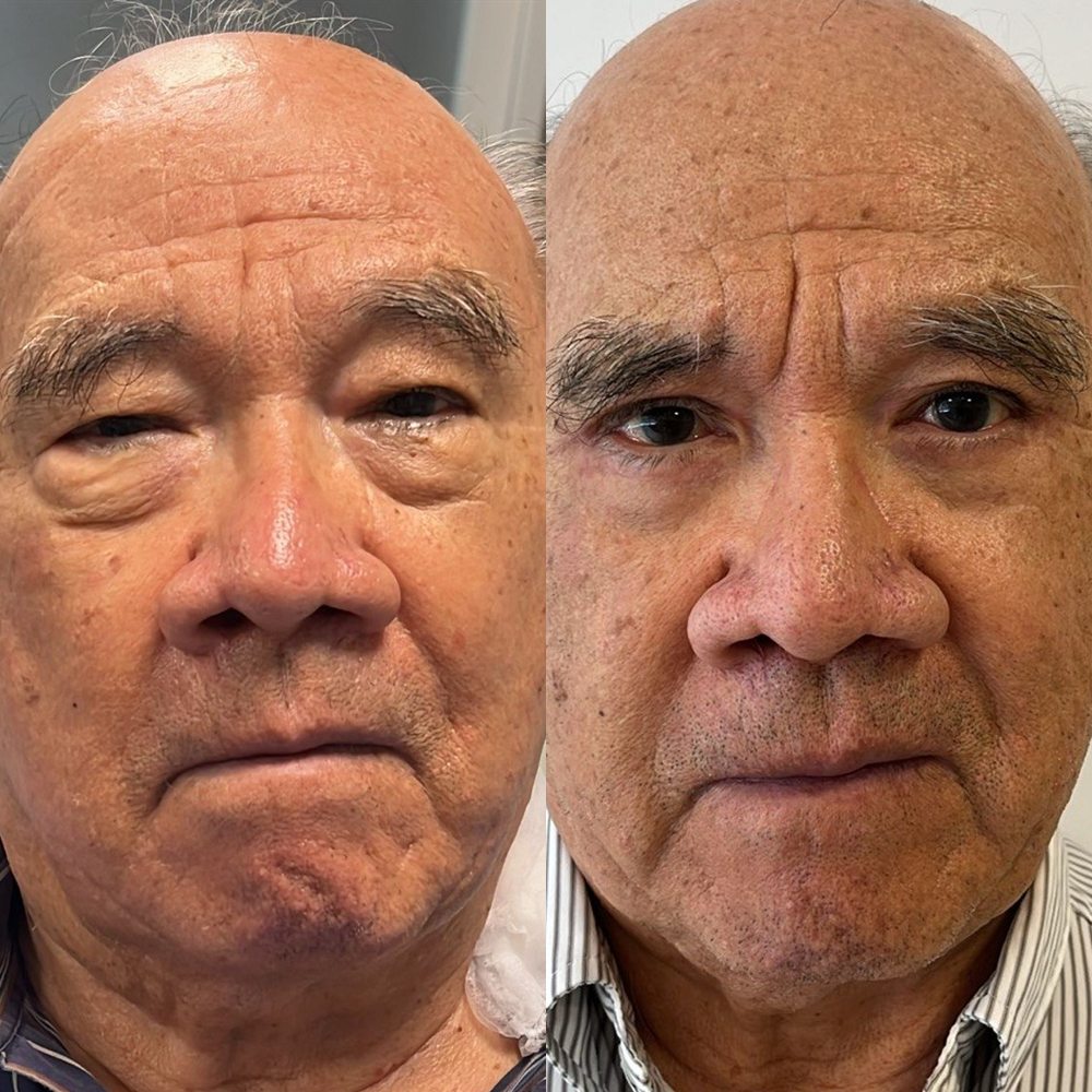 Antes e depois de blefaroplastia