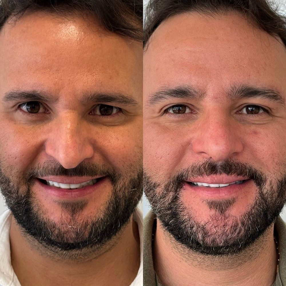Antes e depois de blefaroplastia
