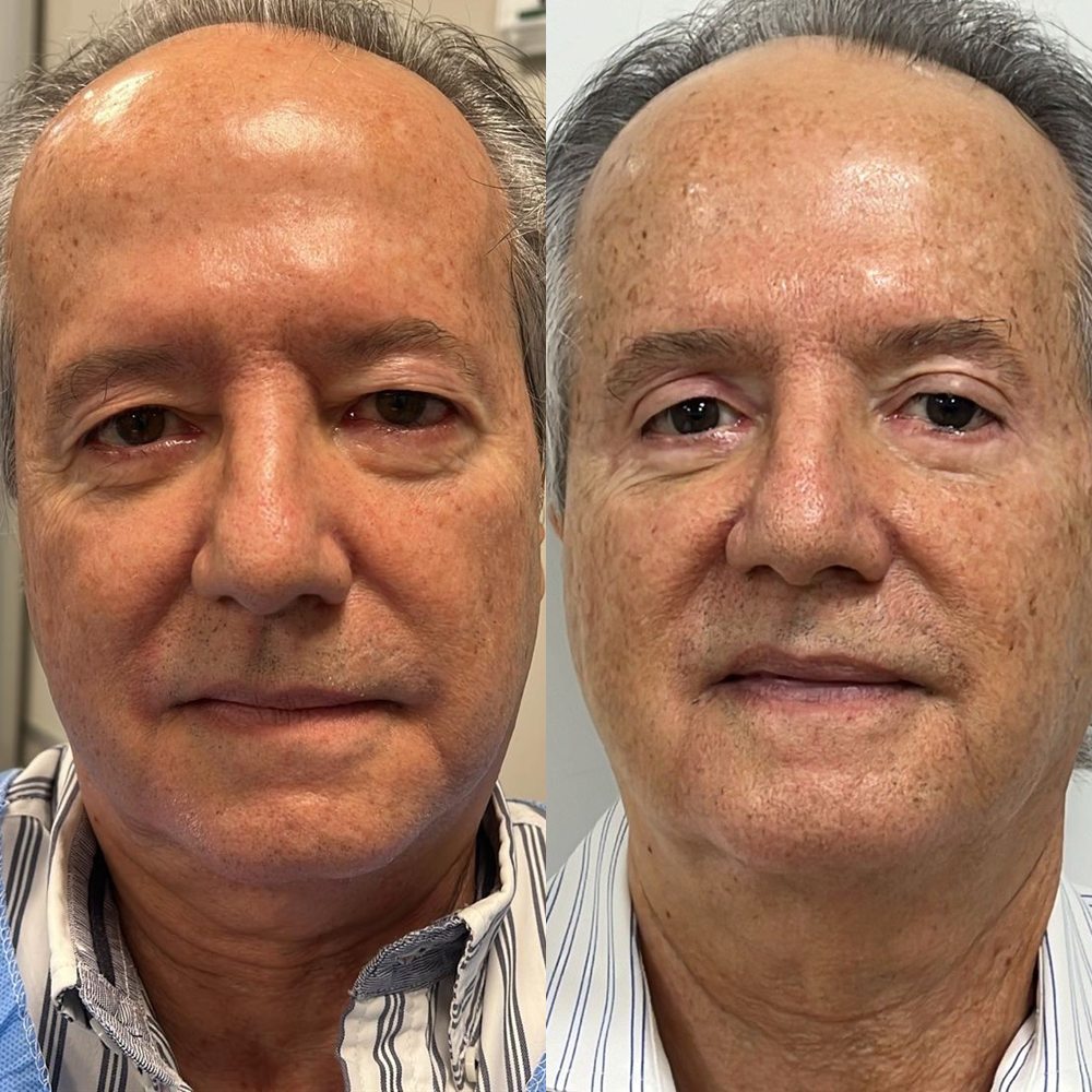 Antes e depois de blefaroplastia