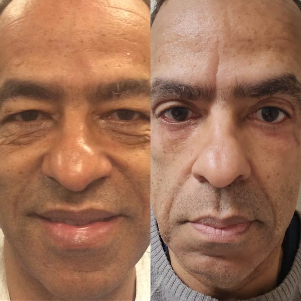 Antes e depois de blefaroplastia
