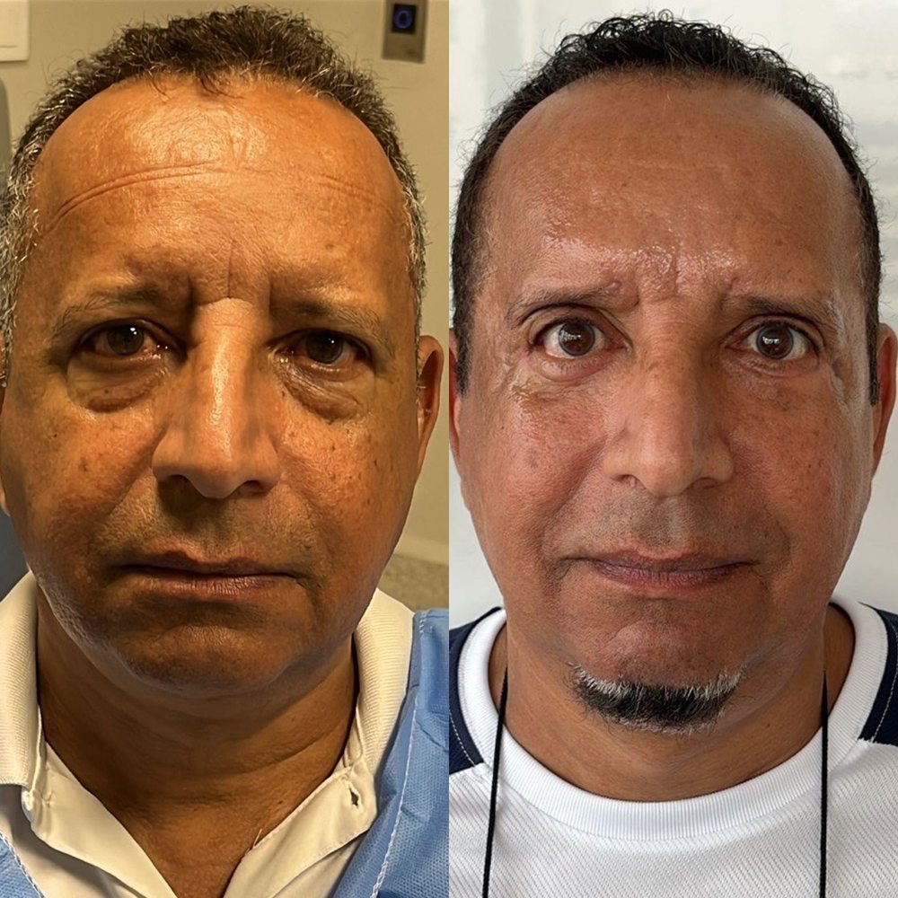 Antes e depois de blefaroplastia