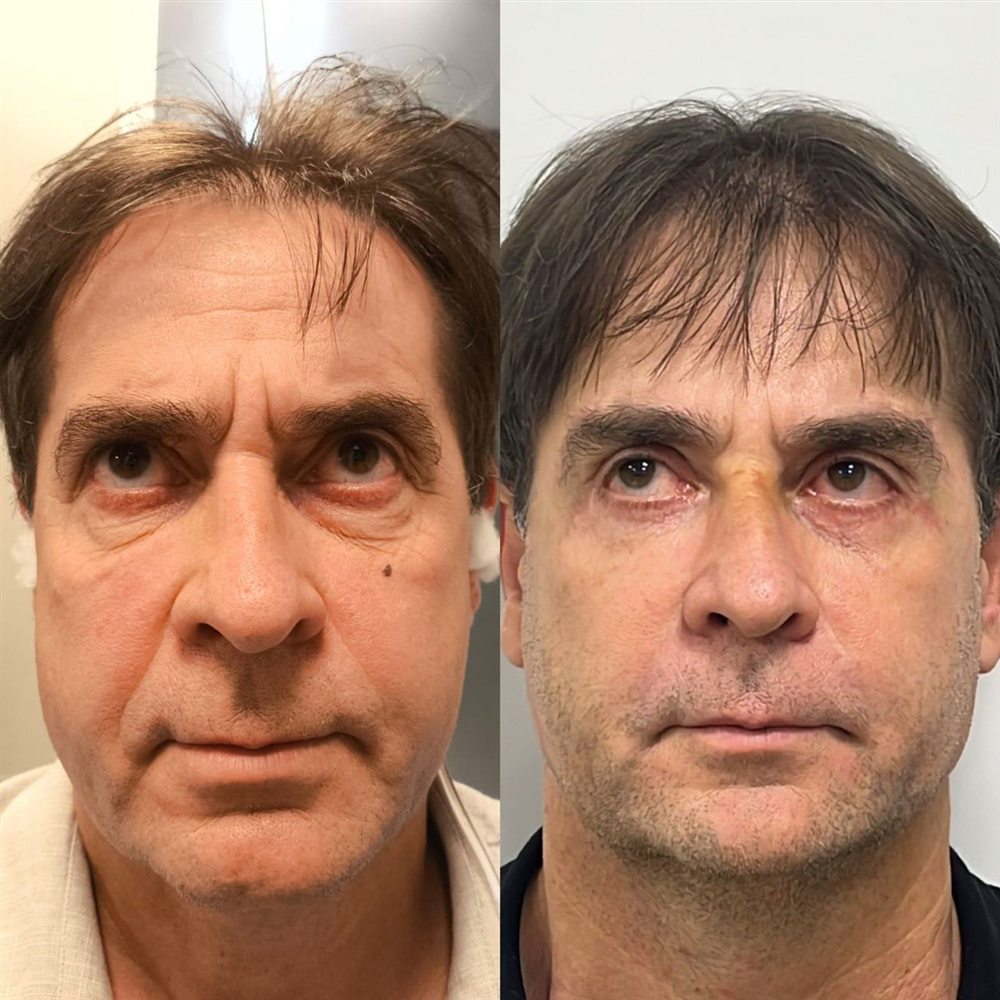 Antes e depois de blefaroplastia