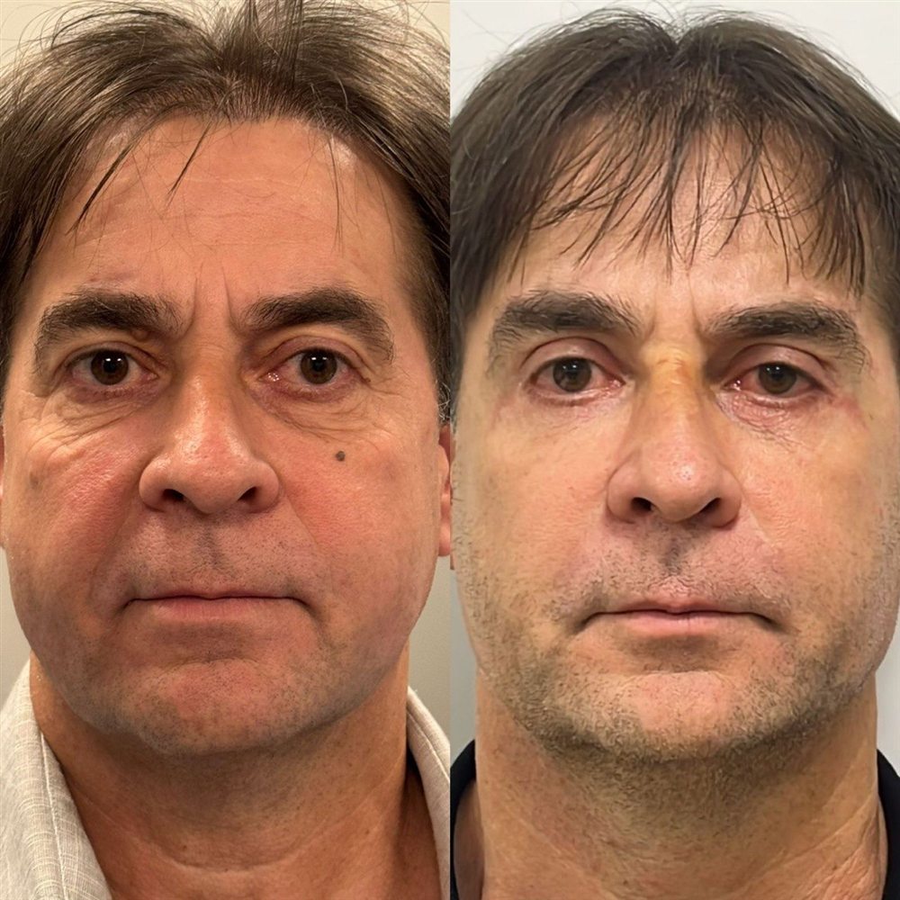 Antes e depois de blefaroplastia