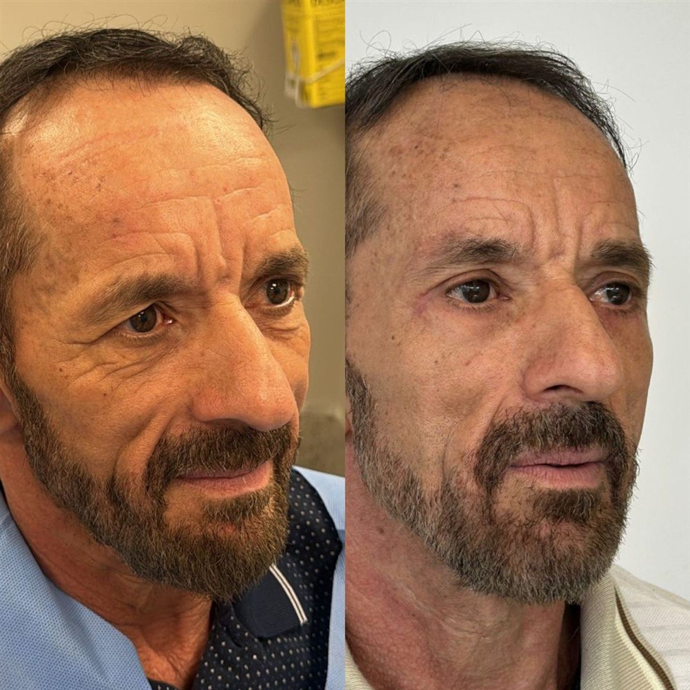 Antes e depois de blefaroplastia