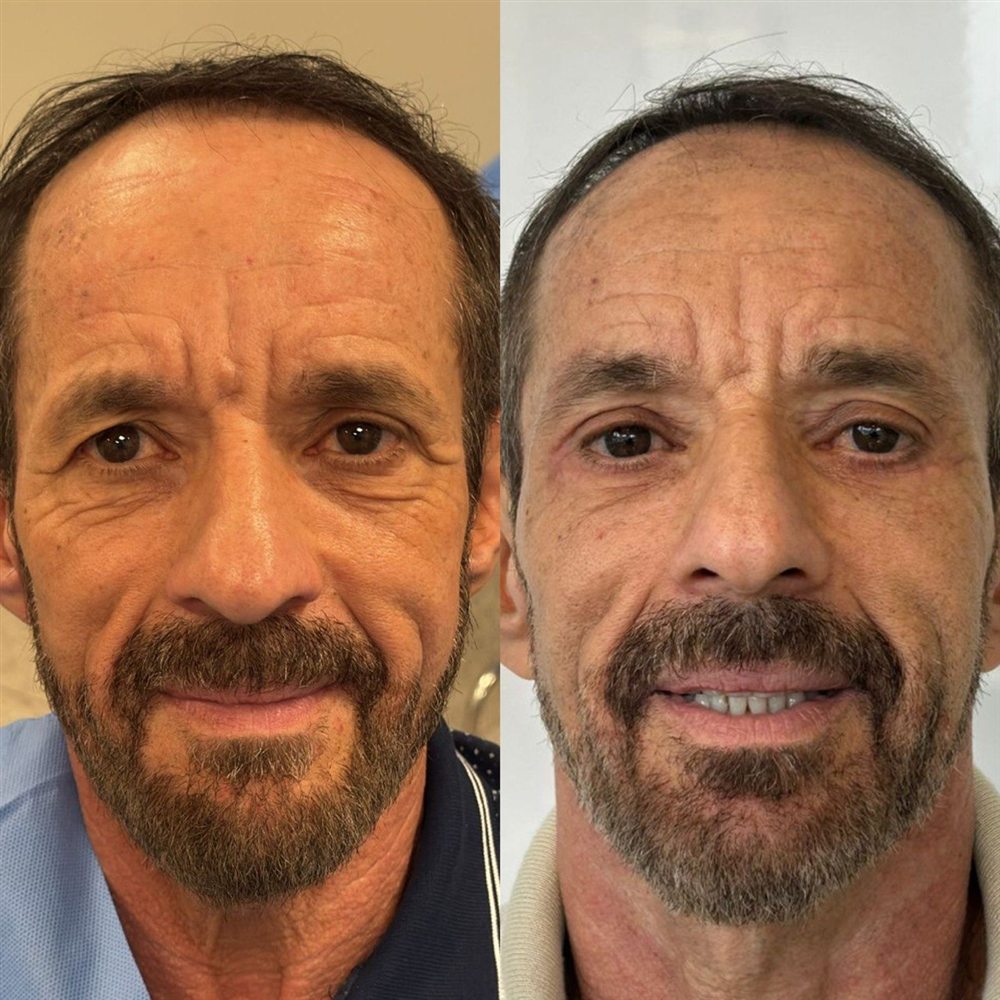 Antes e depois de blefaroplastia