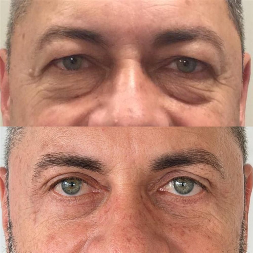 Antes e depois de blefaroplastia