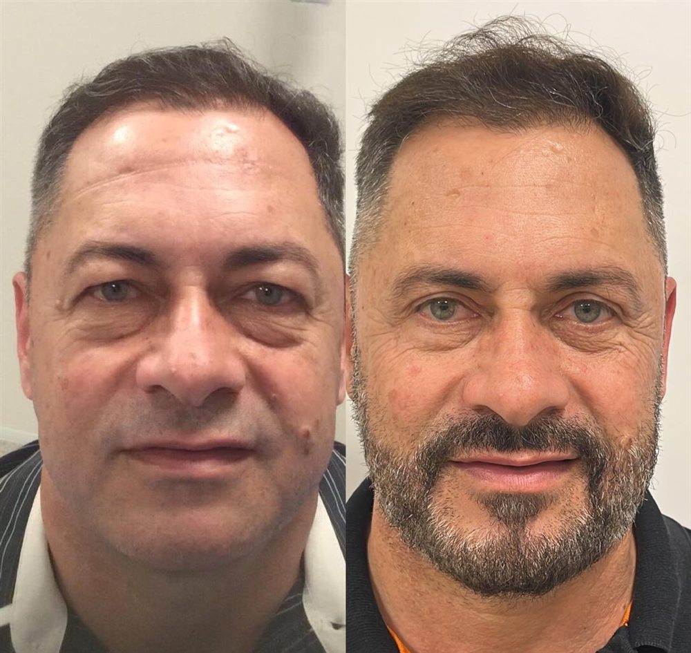 Antes e depois de blefaroplastia