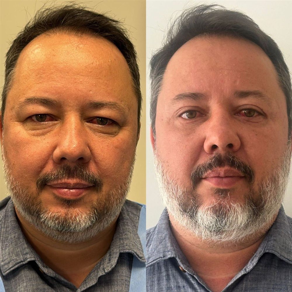 Antes e depois de blefaroplastia