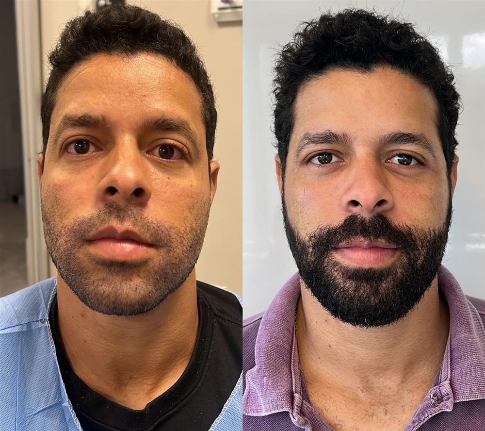 Antes e depois de blefaroplastia