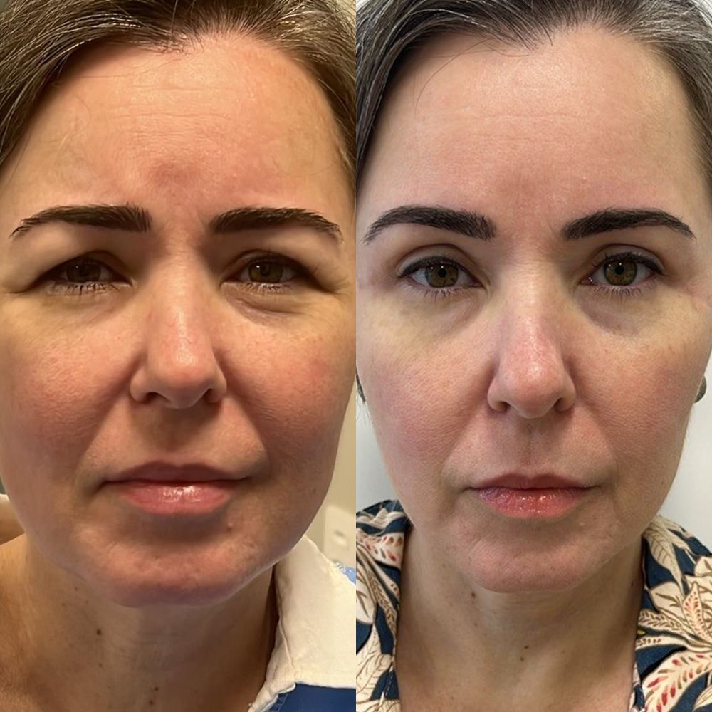 Antes e depois de blefaroplastia