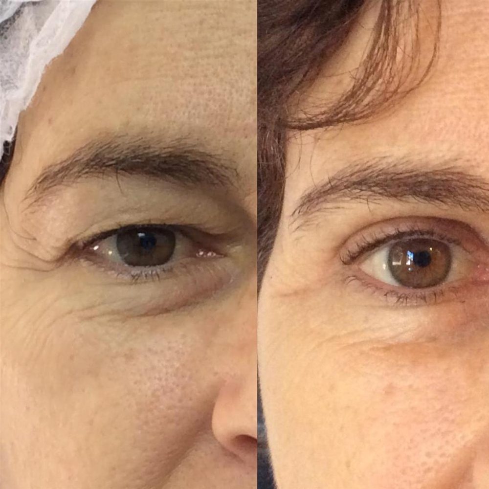 Antes e depois de blefaroplastia