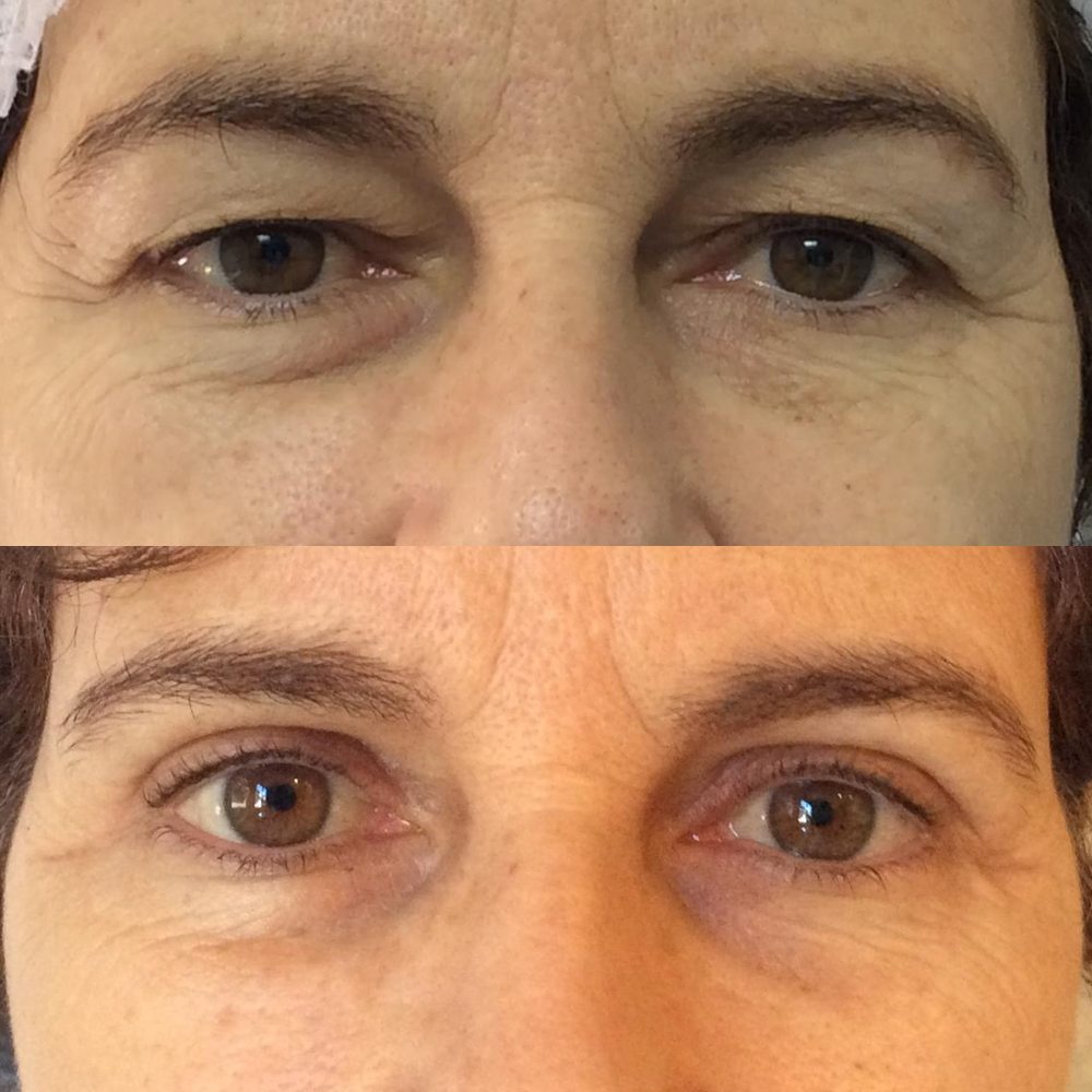 Antes e depois de blefaroplastia