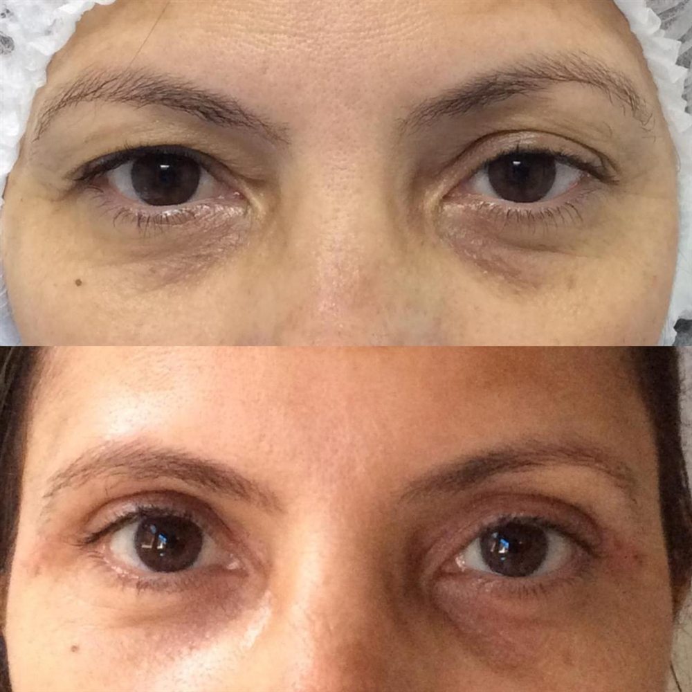 Antes e depois de blefaroplastia