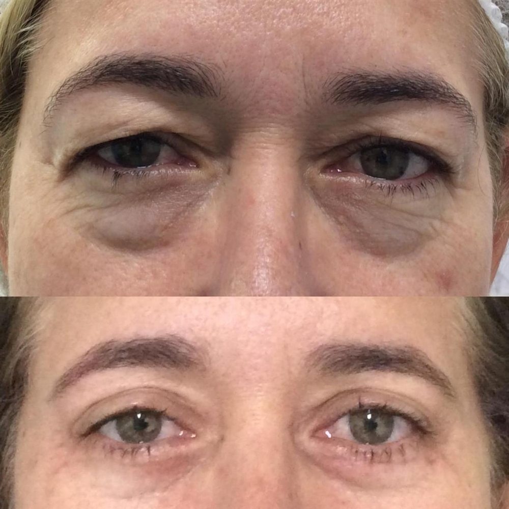 Antes e depois de blefaroplastia