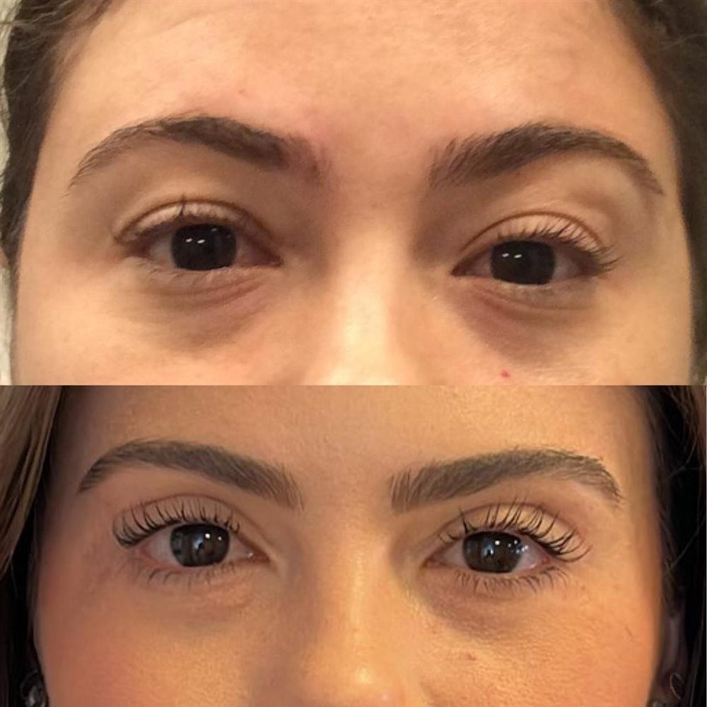Antes e depois de blefaroplastia