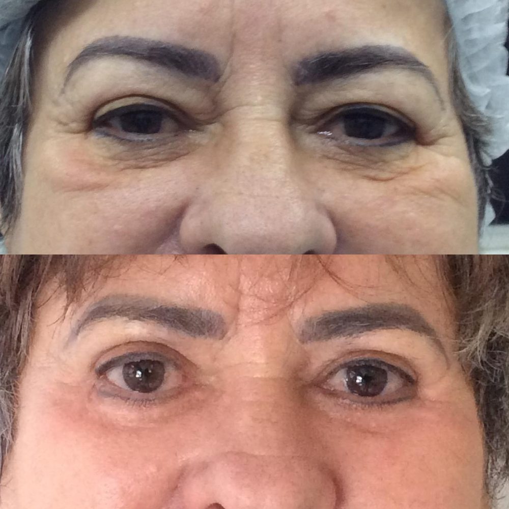 Antes e depois de blefaroplastia