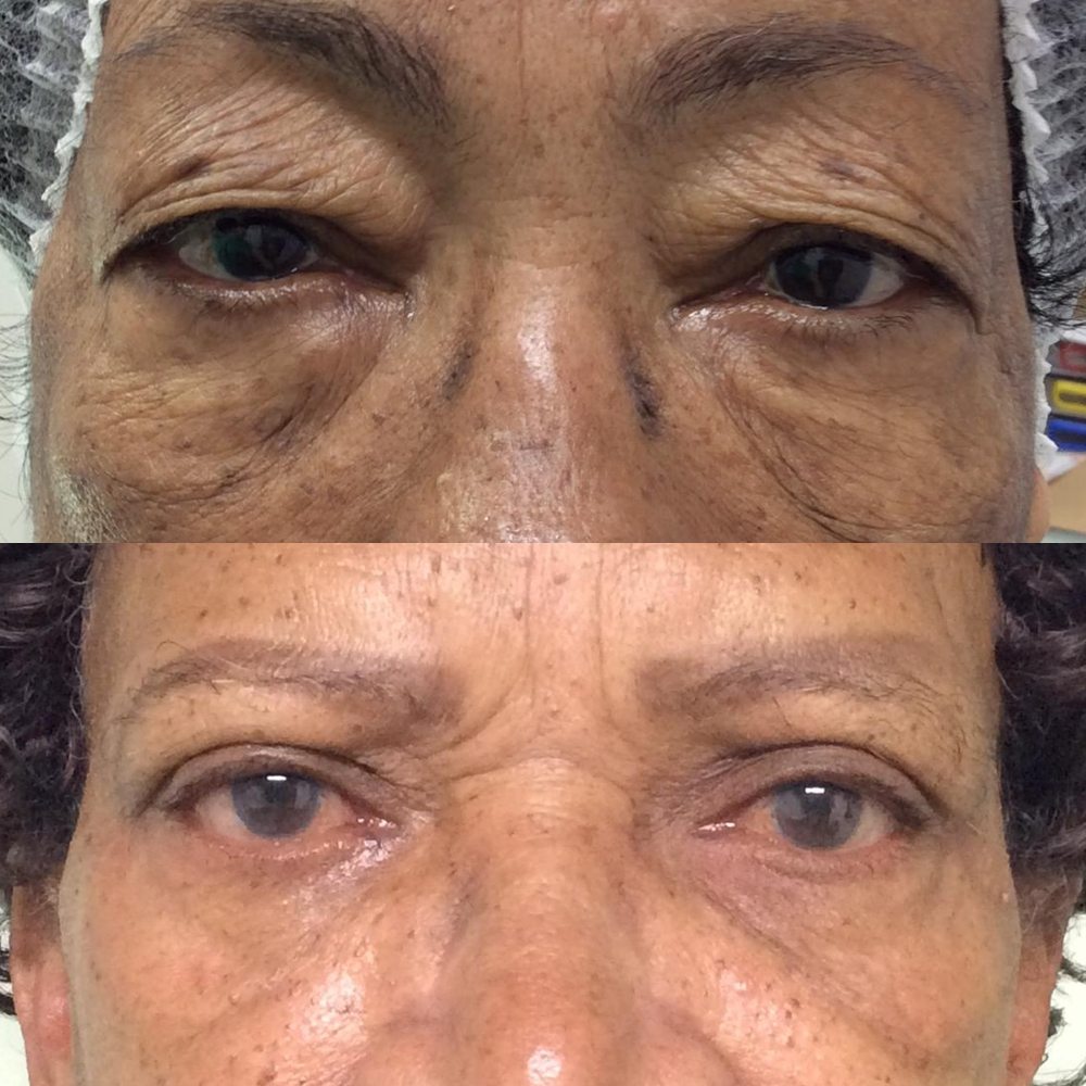 Antes e depois de blefaroplastia