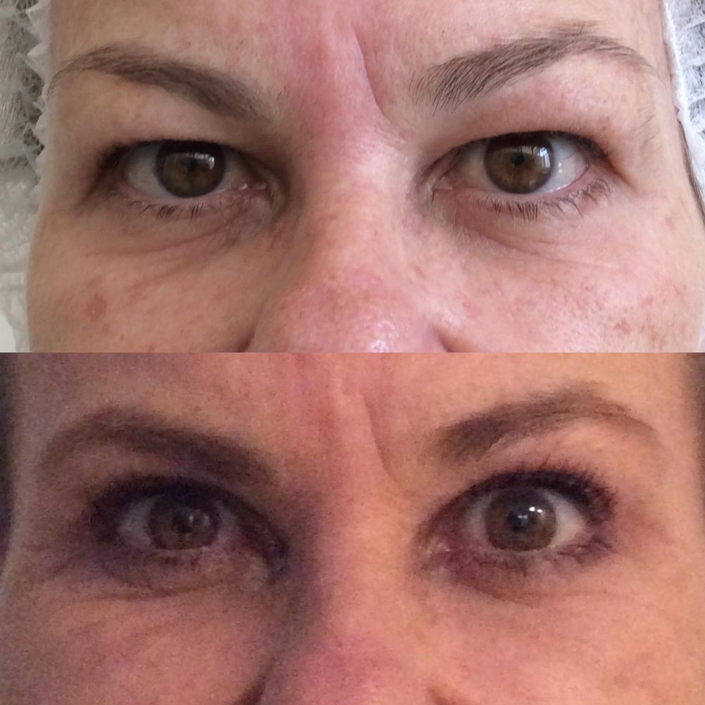 Antes e depois de blefaroplastia