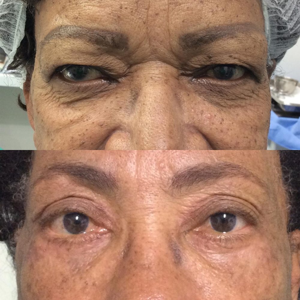 Antes e depois de blefaroplastia