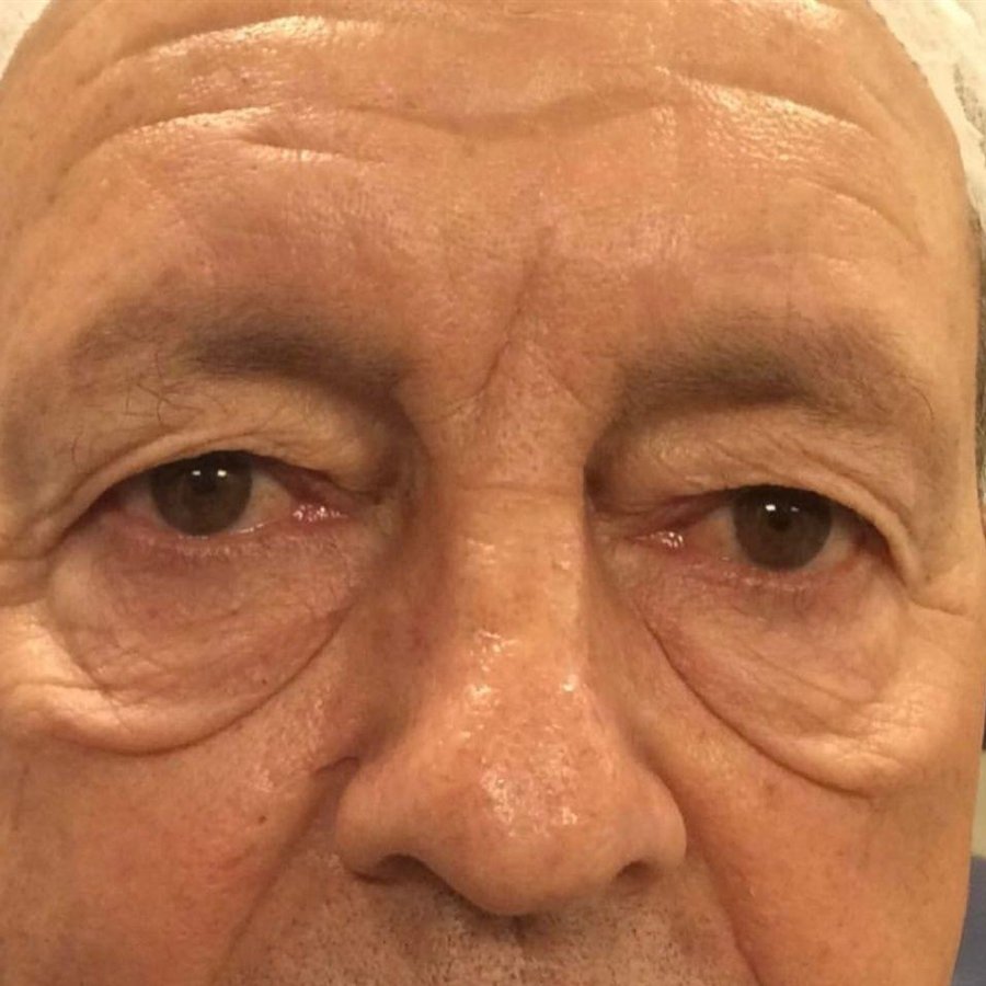 Paciente antes da blefaroplastia