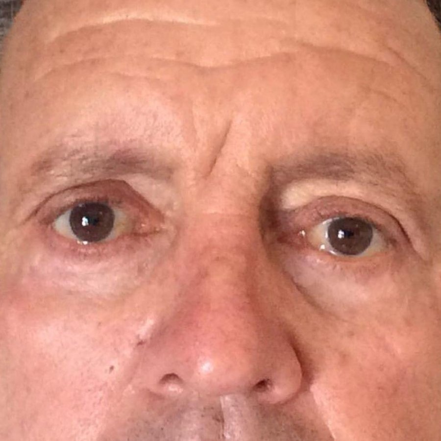 Paciente depois da blefaroplastia
