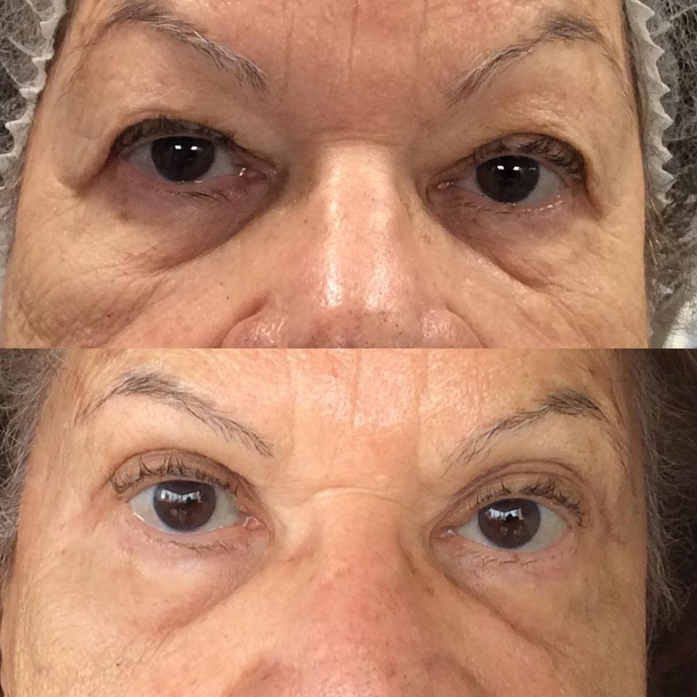 Antes e depois de blefaroplastia