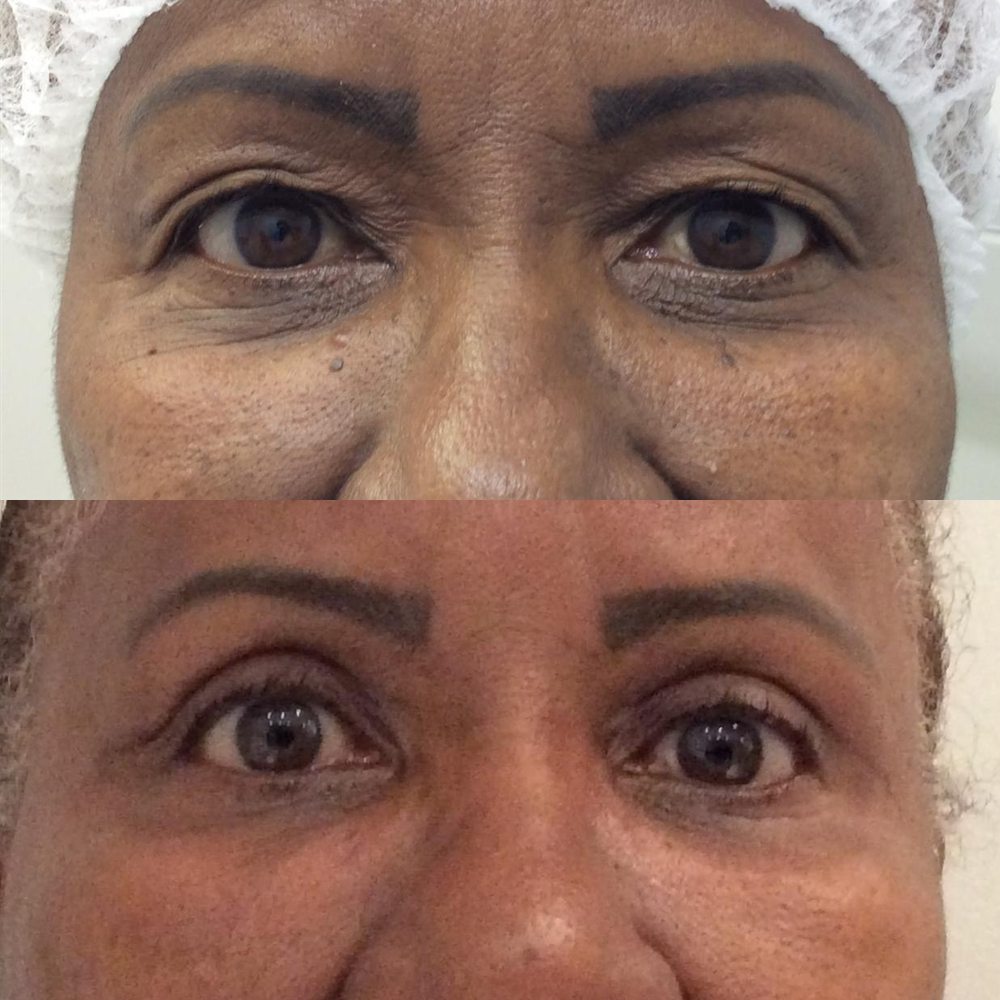 Antes e depois de blefaroplastia